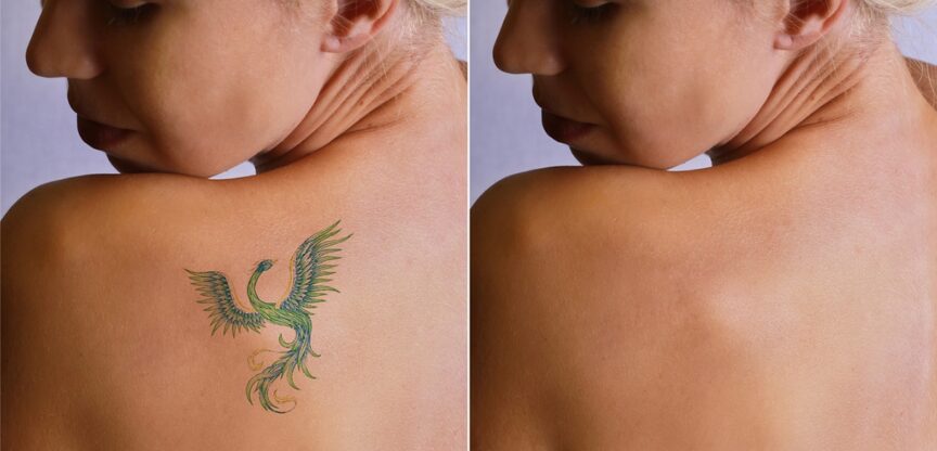 Körperbilder, Tätowierung, Entfernung, Laser, Narbenbildung