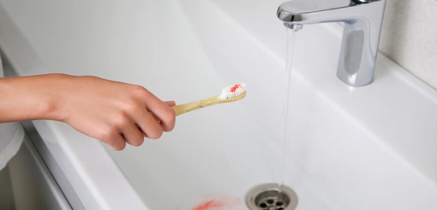 Zahnfleischbluten, Zähne