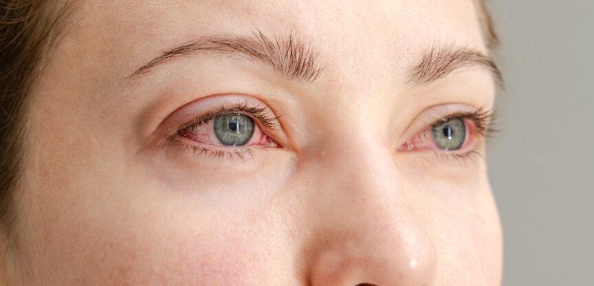 Augenschmerzen, Bindehaut, Tränenfluss, rote Augen