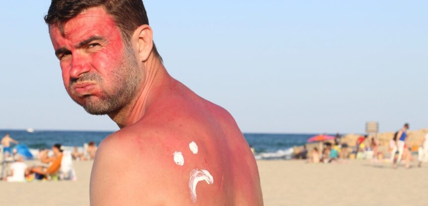 Sonnenbrand-Haut