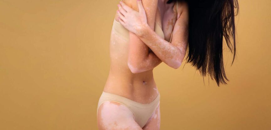 vitiligo
