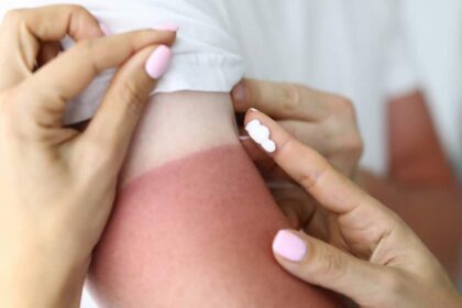 sonnenbrand