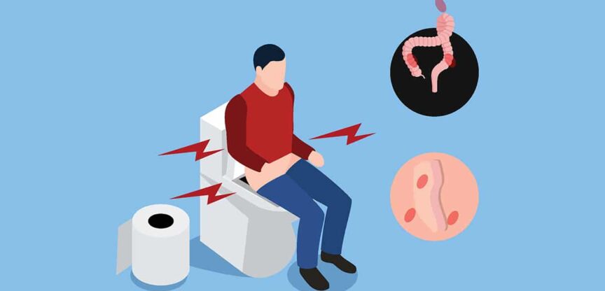Hämorrhoiden