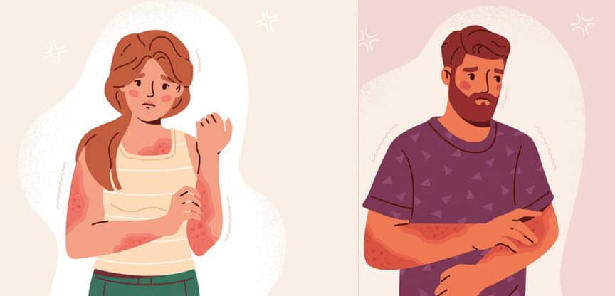 Illustration von Frau und Mann mit Hautausschlag, die sich besorgt die Arme kratzen.