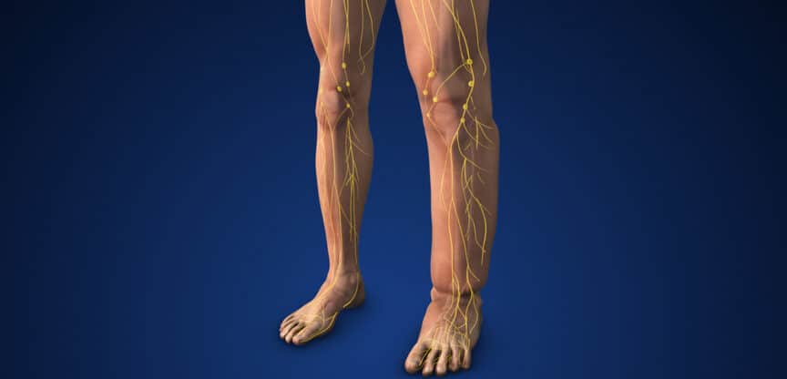 Medizinische Illustration von menschlichen Beinen mit Lymphödem