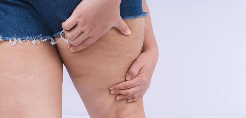 Nahaufnahme einer Person in Jeansshorts, die ihre Oberschenkelhaut zusammendrückt, um Cellulite zu zeigen.