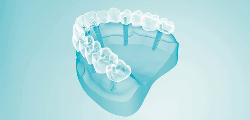 3D-Darstellung eines Kiefermodells mit eingesetzten Zahnimplantaten und durchsichtiger Zahnreihe.