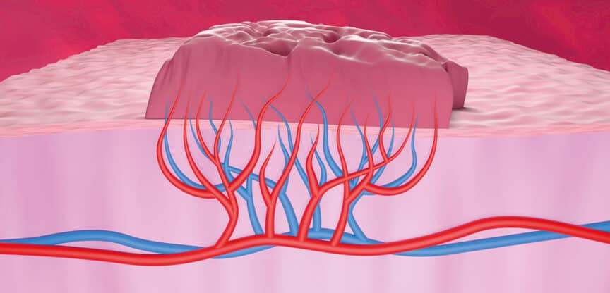 Medizinische Illustration einer Gefäßneubildung