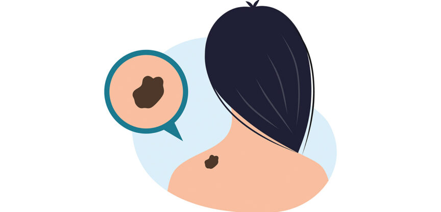 Illustration einer Frau von hinten mit einem auffälligen dunklen Hautfleck auf der Schulter, hervorgehoben durch eine Lupenansicht.