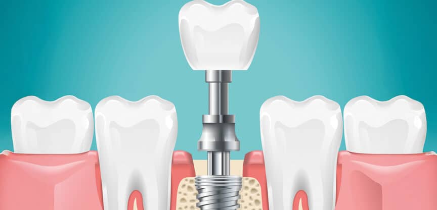 Medizinische Illustration eines Zahnimplantats: Der Aufbau zeigt die einzelnen Komponenten – Implantatschraube im Kieferknochen, Verbindungselement und darauf befestigte Zahnkrone – zwischen natürlichen Zähnen.
