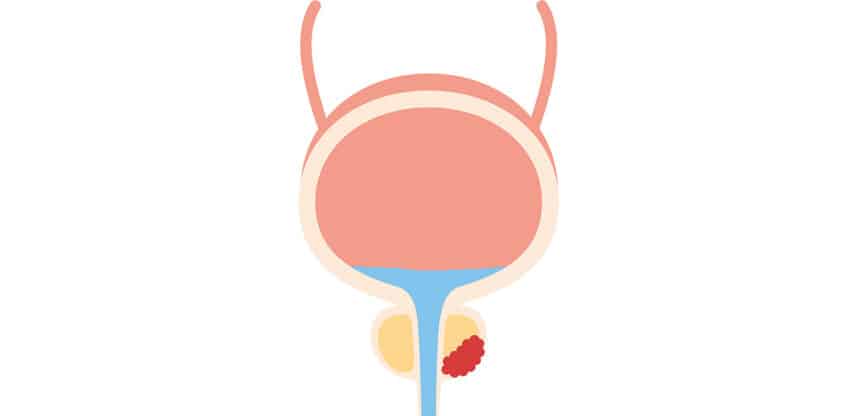 Schematische Darstellung einer menschlichen Blase mit hervorgehobener Prostata und sichtbar markiertem Tumor im unteren Bereich – Hinweis auf Prostatakrebs.