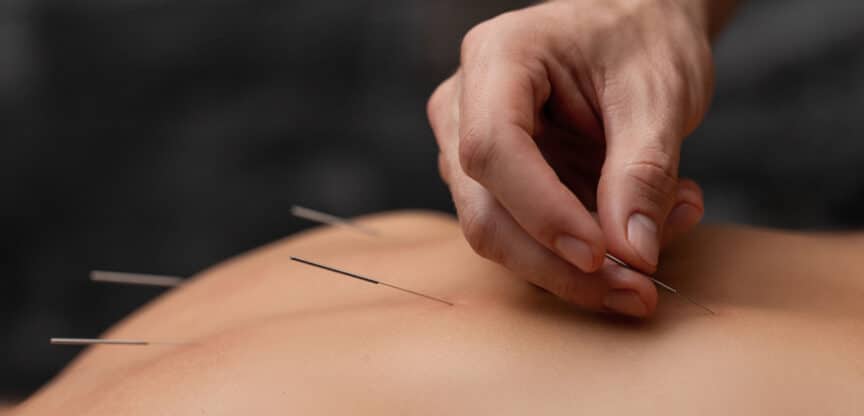 Nahaufnahme einer Hand, die feine Akupunkturnadeln in den Rücken einer Person einführt – eine Szene aus einer traditionellen chinesischen Therapie.
