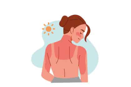 Animation einer Frau mit einem Sonnenbrand