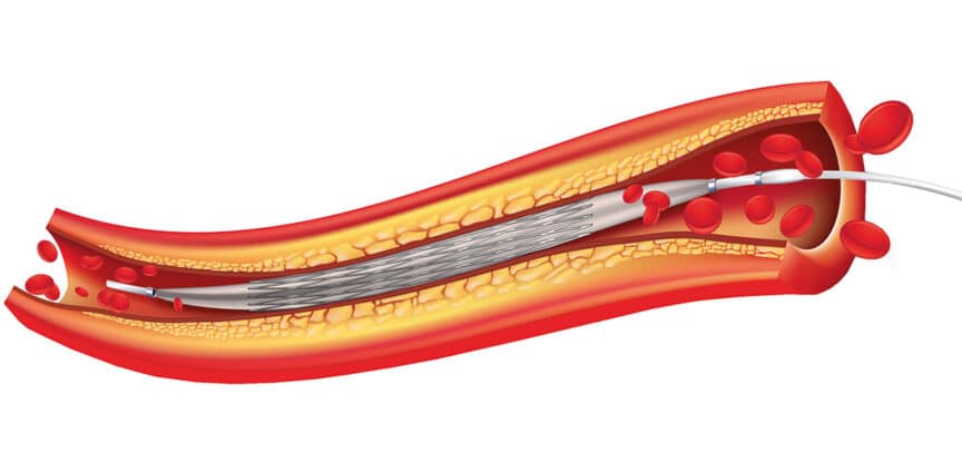 Illustration eines Katheders in einem Gefäß