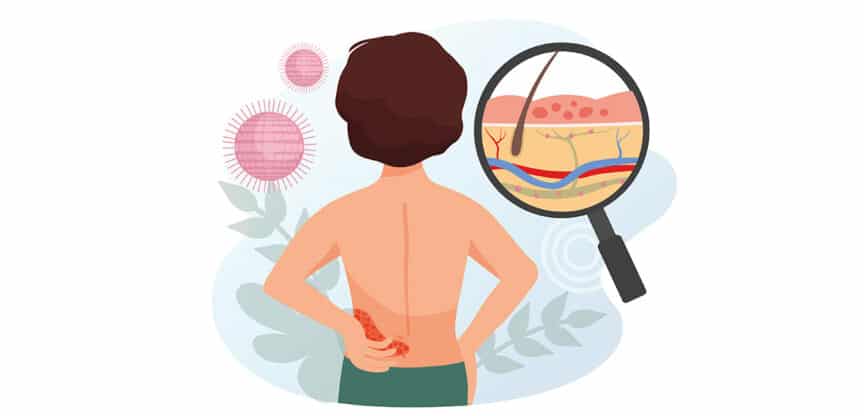 Illustration einer Person mit Gürtelrose am Rücken, Lupe zeigt Hautentzündung mit Bläschen und Viren im Hintergrund.