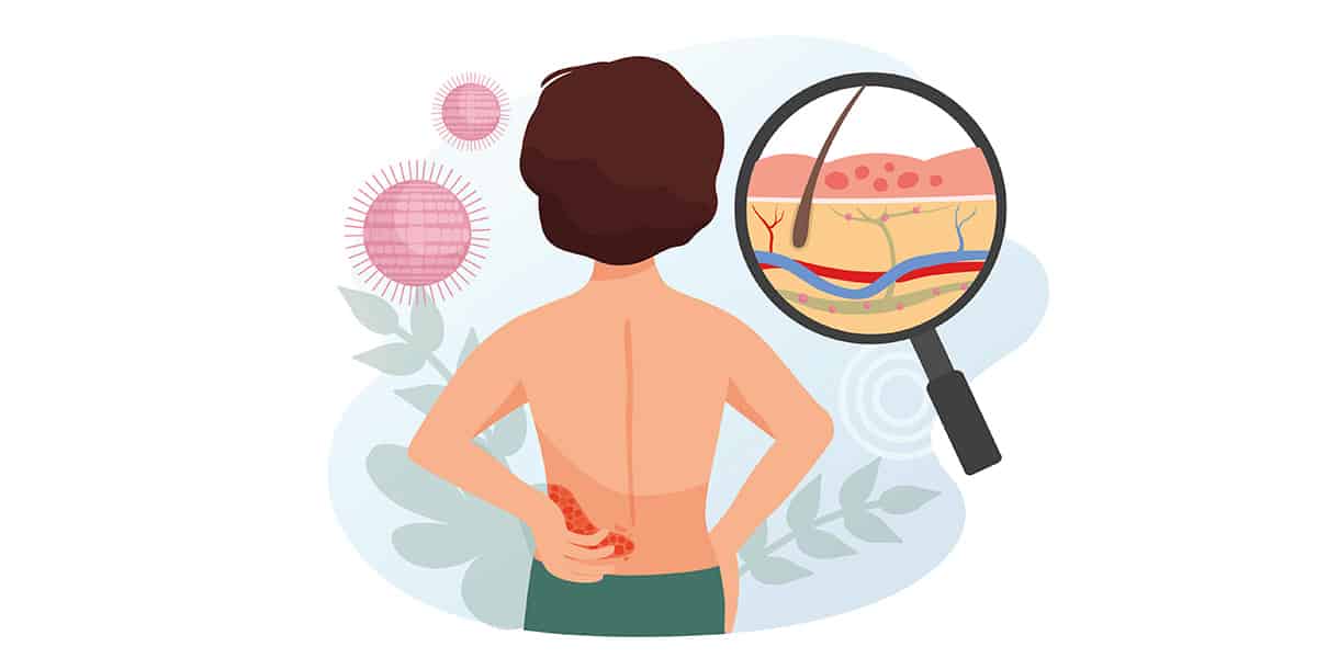Illustration einer Person mit Gürtelrose am Rücken, Lupe zeigt Hautentzündung mit Bläschen und Viren im Hintergrund.