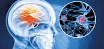 Medizinische Illustration eines Gehirns im Schädel mit hervorgehobenen Nervenzellen und neuronalen Verbindungen im Detail.