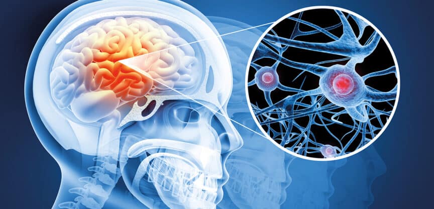 Medizinische Illustration eines Gehirns im Schädel mit hervorgehobenen Nervenzellen und neuronalen Verbindungen im Detail.