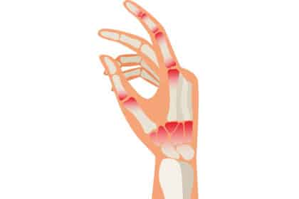 Illustration einer Hand mit sichtbaren Knochen und rot markierten Gelenken als Hinweis auf Arthritis oder Entzündung.