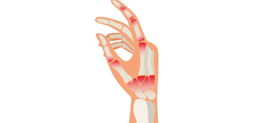 Illustration einer Hand mit sichtbaren Knochen und rot markierten Gelenken als Hinweis auf Arthritis oder Entzündung.