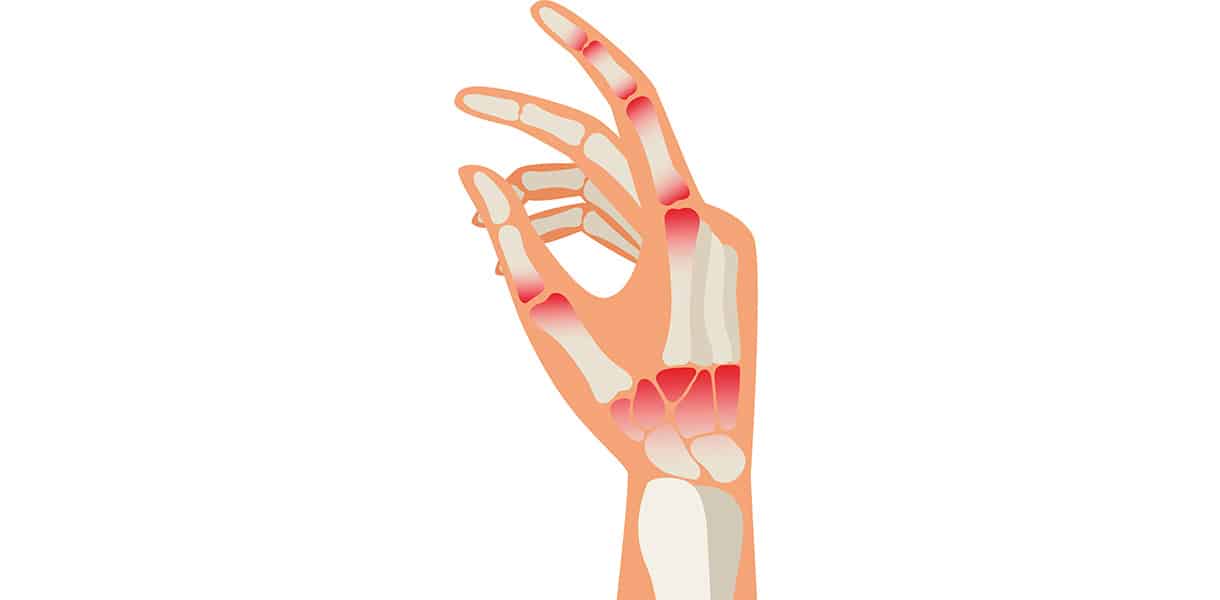 Illustration einer Hand mit sichtbaren Knochen und rot markierten Gelenken als Hinweis auf Arthritis oder Entzündung.