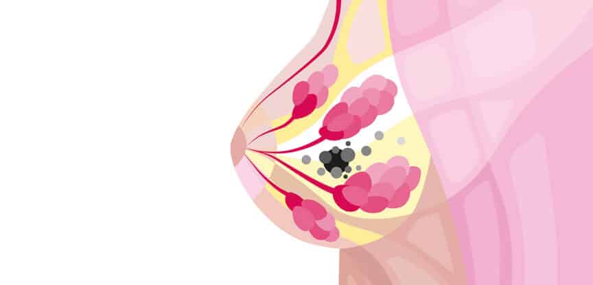 Illustration einer weiblichen Brust im Querschnitt mit Milchdrüsen und markierten Gewebeveränderungen.