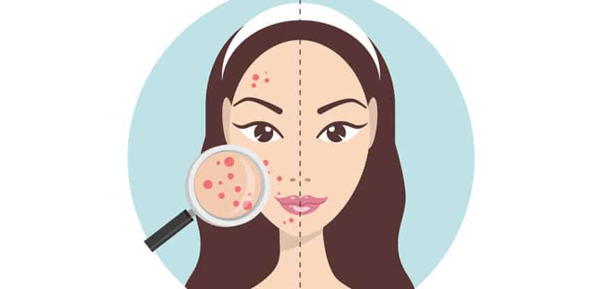 Illustration eines Gesichts, halb mit Akne und halb mit klarer Haut, vergrößert durch eine Lupe zur Hautanalyse.