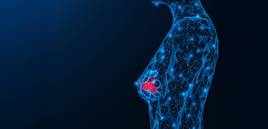 Digitale Illustration einer Brust mit rotem Bereich, symbolisch für Tumor oder Krebs.