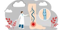 Illustration eines Beins mit Krampfadern, rotem Schmerzpunkt und vergrößertem Venenquerschnitt, daneben steht eine Arztfigur zur Diagnose.