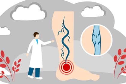 Illustration eines Beins mit Krampfadern, rotem Schmerzpunkt und vergrößertem Venenquerschnitt, daneben steht eine Arztfigur zur Diagnose.
