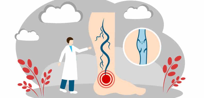 Illustration eines Beins mit Krampfadern, rotem Schmerzpunkt und vergrößertem Venenquerschnitt, daneben steht eine Arztfigur zur Diagnose.
