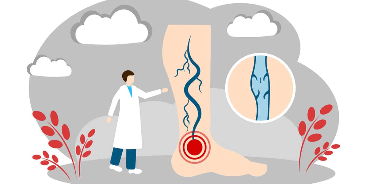 Illustration eines Beins mit Krampfadern, rotem Schmerzpunkt und vergrößertem Venenquerschnitt, daneben steht eine Arztfigur zur Diagnose.