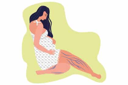 Illustration einer schwangeren Frau mit sichtbaren blauen Venen an den Beinen – Darstellung von Schwangerschaftsvarizen.