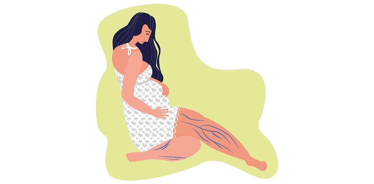Illustration einer schwangeren Frau mit sichtbaren blauen Venen an den Beinen – Darstellung von Schwangerschaftsvarizen.