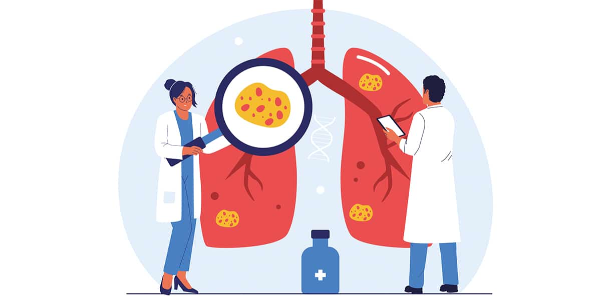 Illustration zweier Ärzt:innen, die erkrankte Lungen untersuchen; Lupe zeigt auffällige gelbe Flecken in der Lunge.