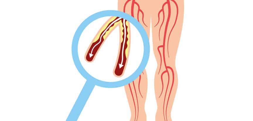 Illustration von Beinen mit hervorgehobenen Blutgefäßen, Vergrößerung zeigt verengte Arterien durch Ablagerungen.