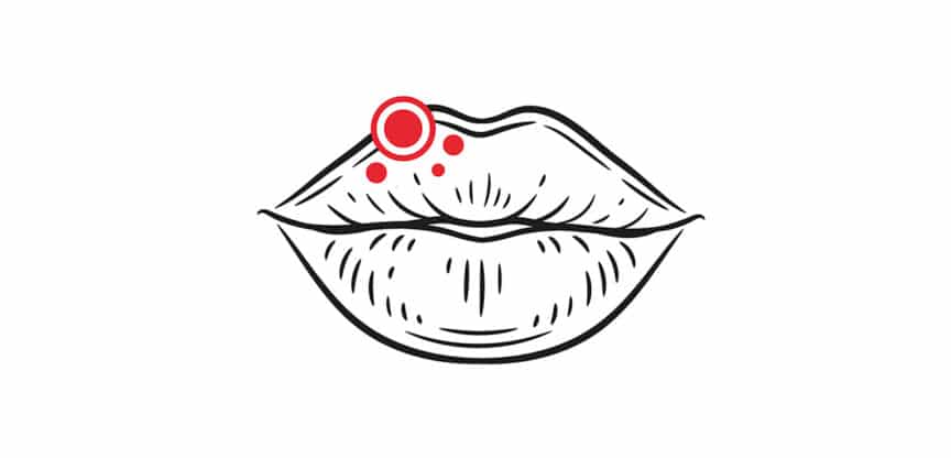 Illustration einer Lippe mit Fieberblase