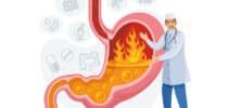 Illustration eines Arztes neben einem Magen mit Flammen, die starkes Sodbrennen oder Magensäure darstellen.