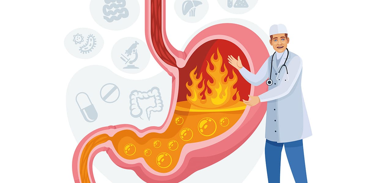 Illustration eines Arztes neben einem Magen mit Flammen, die starkes Sodbrennen oder Magensäure darstellen.