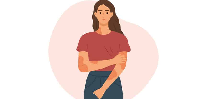 Illustration einer Frau mit sichtbarem Hautausschlag an Armen und Hals.