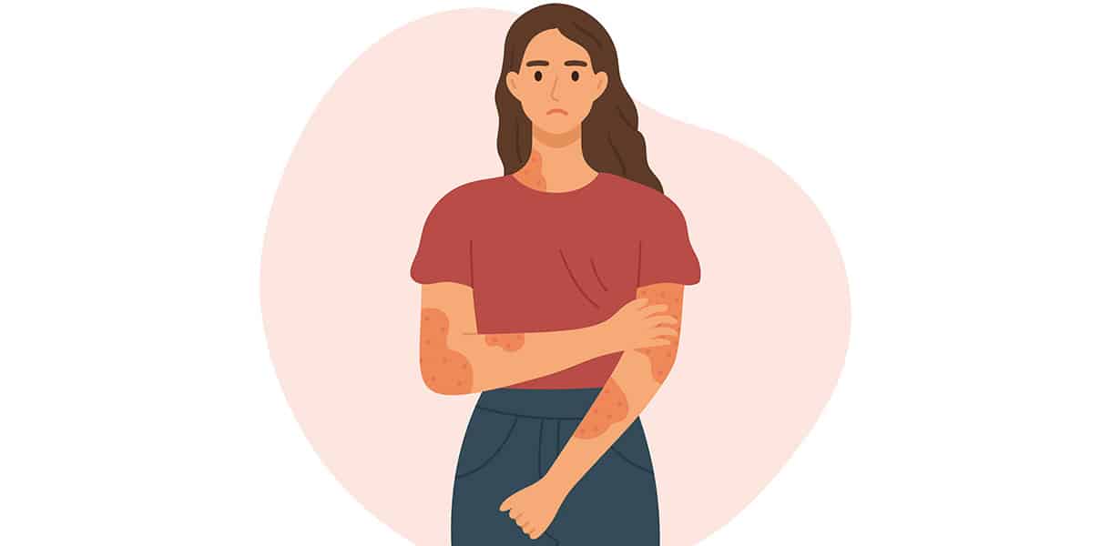 Illustration einer Frau mit sichtbarem Hautausschlag an Armen und Hals.