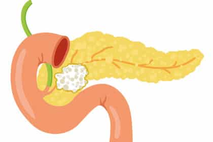 Illustration der Bauchspeicheldrüse mit tumorartiger Veränderung im Bereich des Pankreaskopfes.