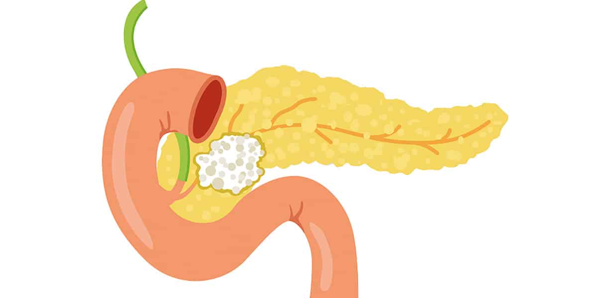Illustration der Bauchspeicheldrüse mit tumorartiger Veränderung im Bereich des Pankreaskopfes.