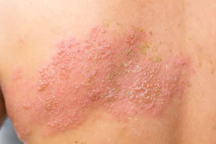 Typisch für Gürtelrose ist ein Bläschenausschlag, der üblicherweise einseitig auftritt.