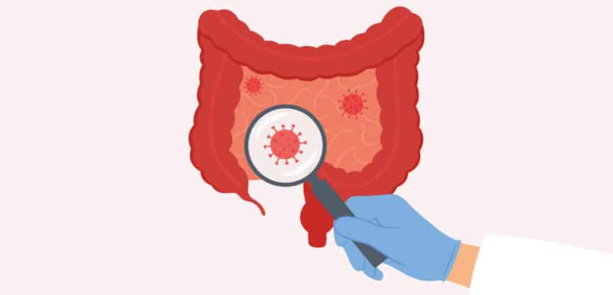 Illustration eines Darms, in dem mit einer Lupe entzündliche oder schädliche Strukturen hervorgehoben werden.