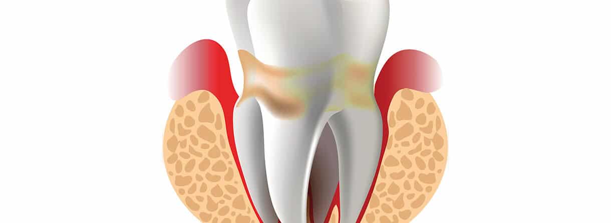 Vektor-Bild von einem Zahn mit Parodontitis.
