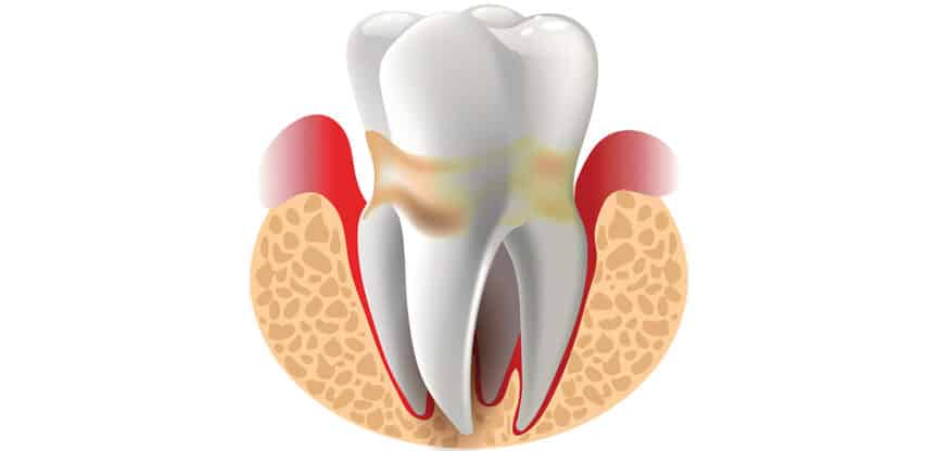 Vektor-Bild von einem Zahn mit Parodontitis.