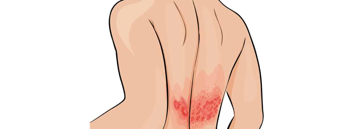 Illustration eines Rückens mit einem entzündlichen Hautausschlag im unteren Bereich.