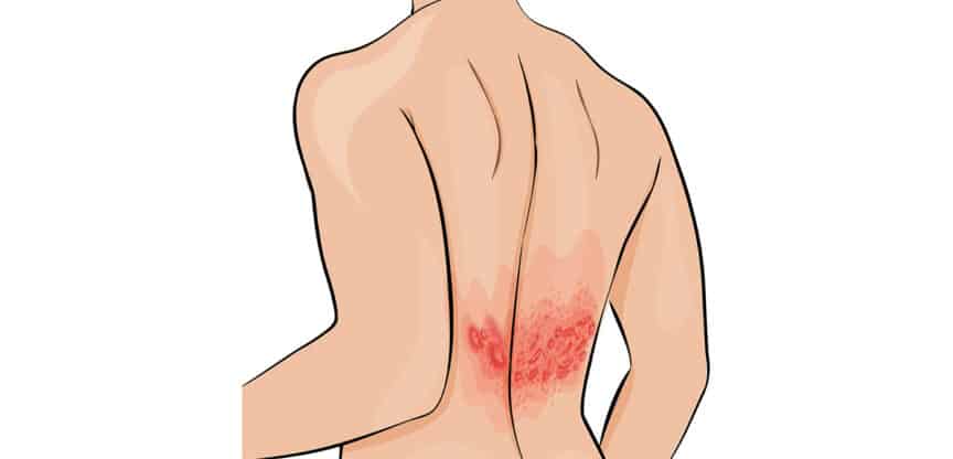 Illustration eines Rückens mit einem entzündlichen Hautausschlag im unteren Bereich.