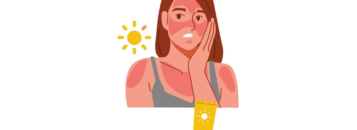 Illustration einer Frau mit starkem Sonnenbrand im Gesicht und an den Schultern sowie einer Sonnencreme-Tube als Symbol für UV-Schutz.